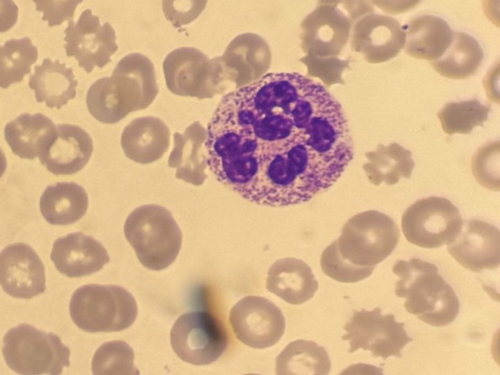 Blood smear: hypersegmented neutrophil (macropolicyte) in MDS