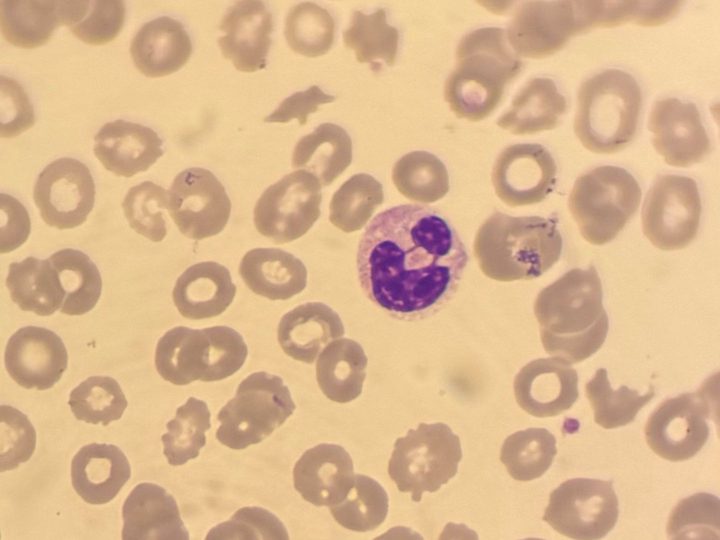 Blood smear: neutrophil with segmentation abnormality and a ring-shaped nucleus