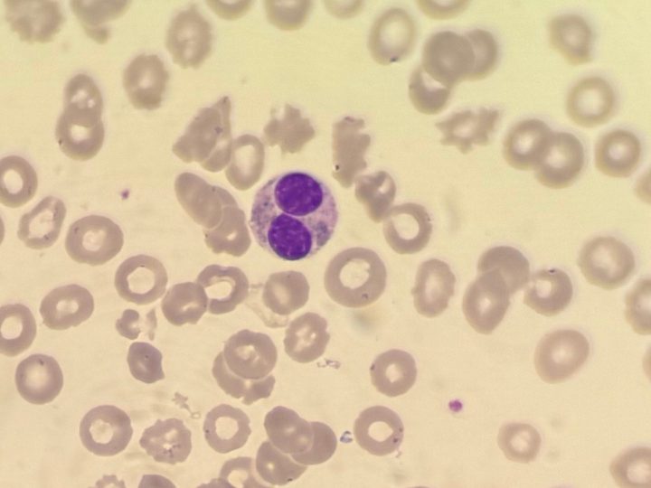 Peripheral blood smear: Pelgeroid neutrophil with two segments