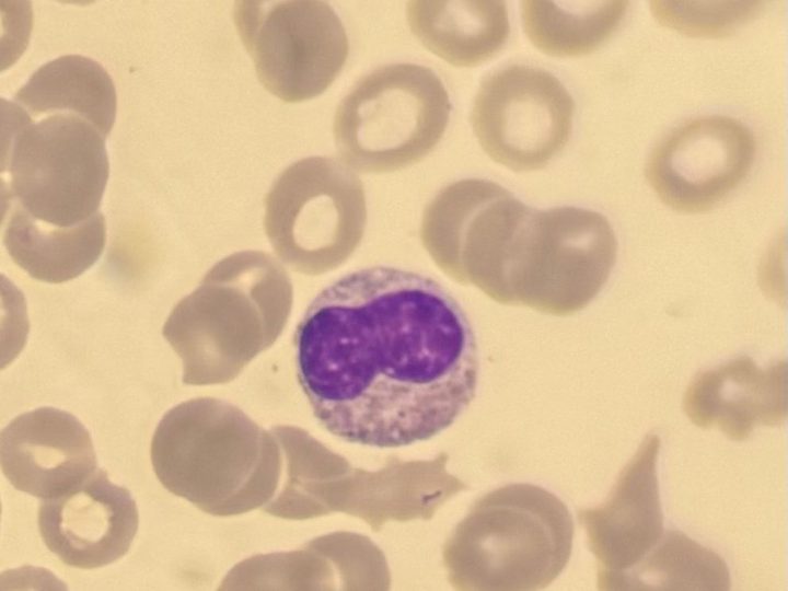 Blood smear: hyposegmented neutrophil with dense chromatin