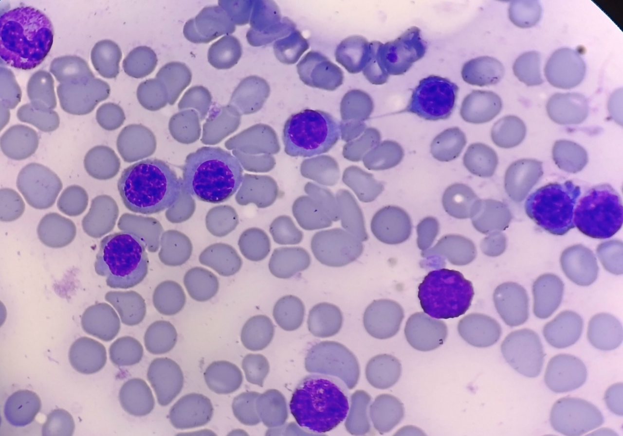 Erythroid Dysplasia in Bone Marrow