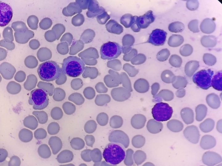 Bone marrow smear: megaloblastoid erythrocaryocytes with maturation abnormalities