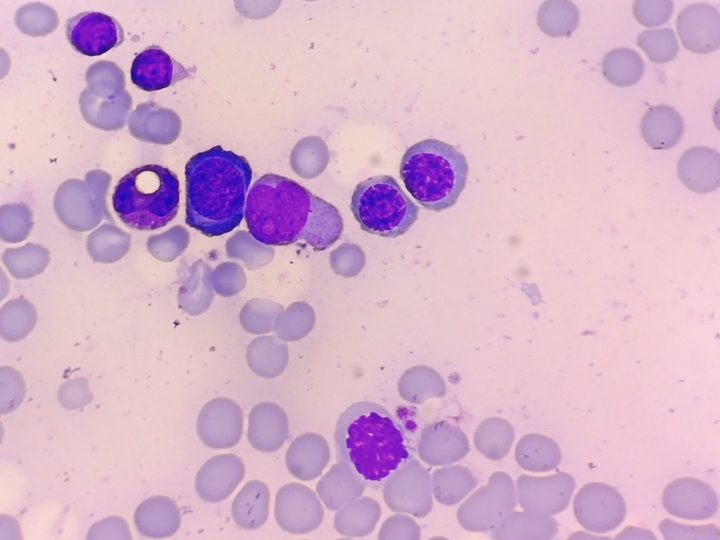 Bone marrow smear: basophilic normoblasts with cytoplasmic vacuolization
