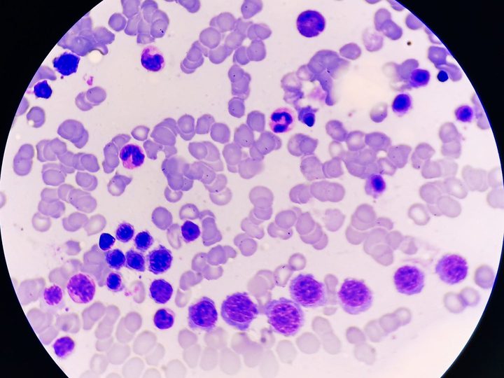 Bone marrow smear: pronounced hyperplasia of the erythroid cell lineage