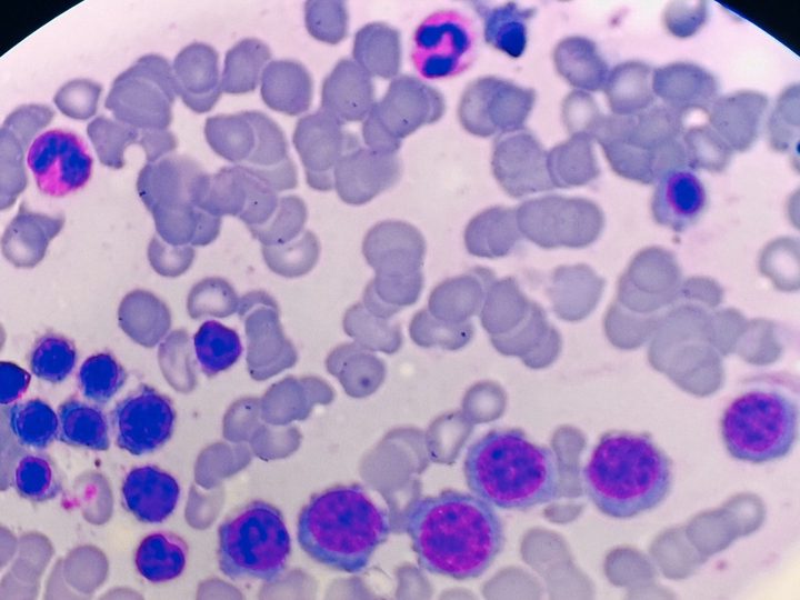 Bone marrow smear: chain of normoblasts with intercellular bridges