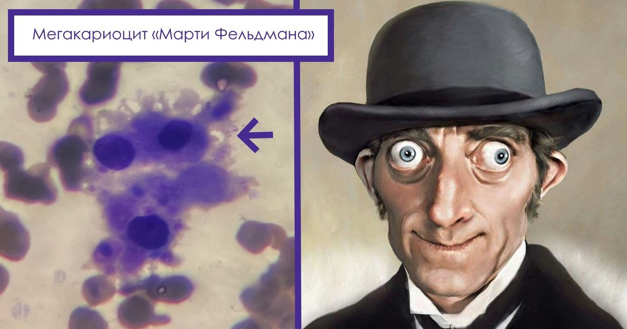 Дисплазия мегакариоцитов при миелодиспластическом синдроме