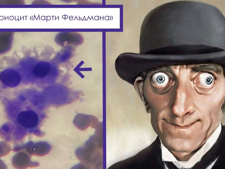 Мазок костного мозга и иллюстрация: многоядерный микромегакариоцит