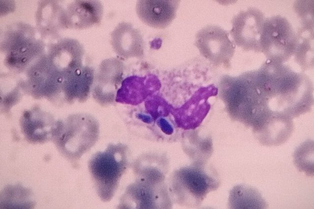 Disseminated Candidiasis in Peripheral Blood Smear