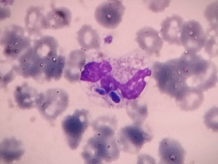 Blood smear: neutrophil with phagocytosed Candida cells in the cytoplasm