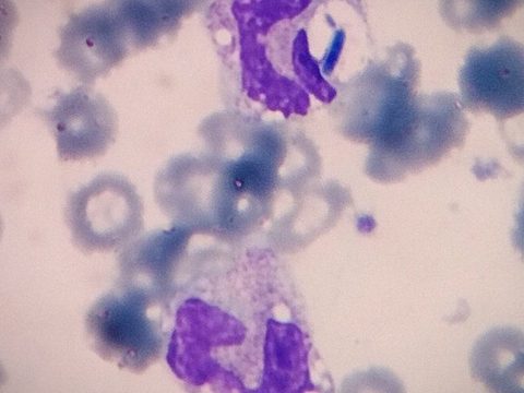 Blood smear: vacuolization of neutrophils and phagocytosis of Candida pseudomycelium