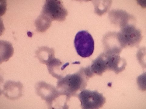 Blood smear: free Candida yeast cells next to the leukocyte nucleus