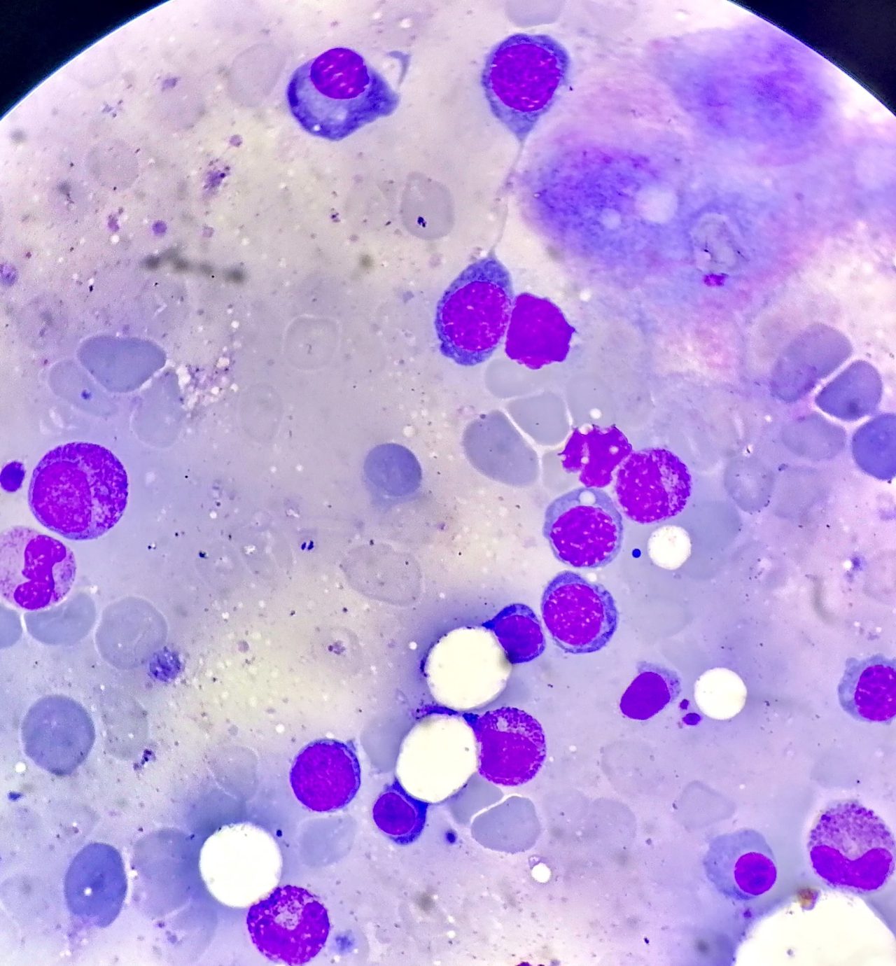 Dyserythropoiesis in Bone Marrow: Intercellular Bridges