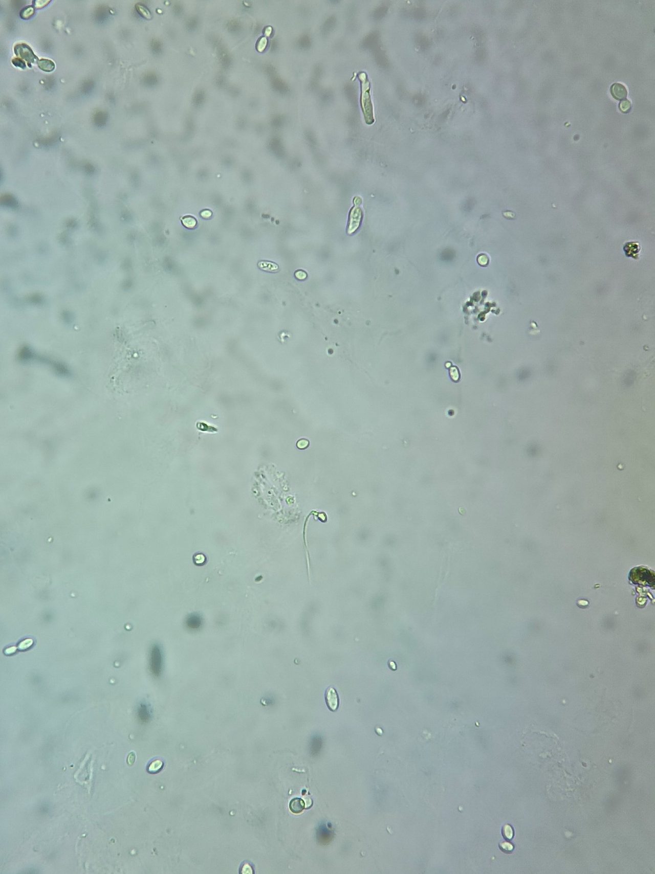 Yeast-like Fungi and Spermatozoa in Urine Sediment