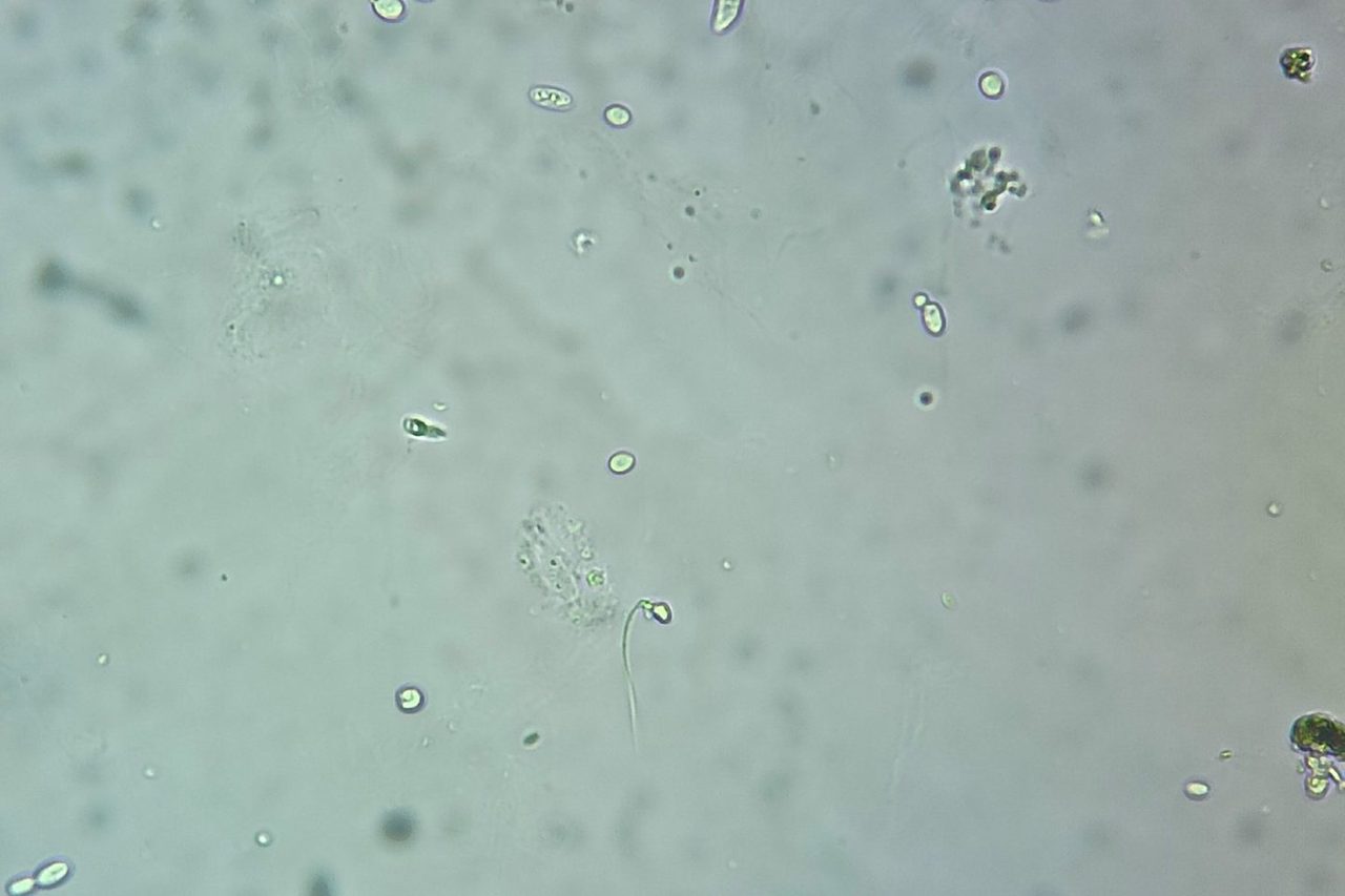 Yeast-like Fungi and Spermatozoa in Urine Sediment