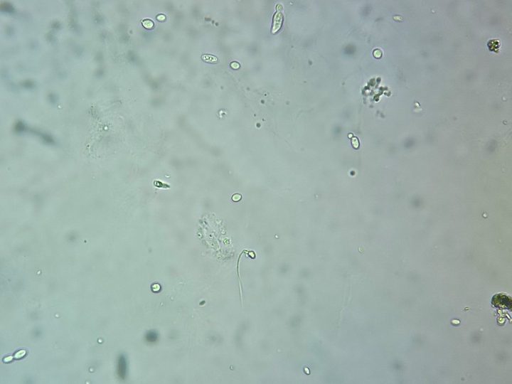 Native urine sediment preparation: a single spermatozoon and budding yeast cells