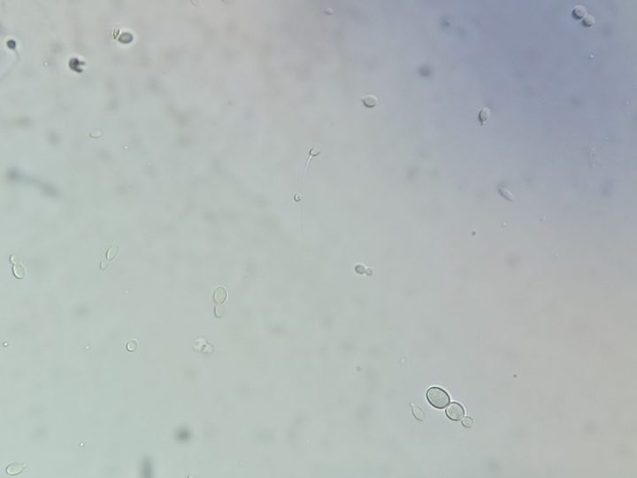 Microscopy of urine sediment: budding yeast cells and a spermatozoon in the field of view