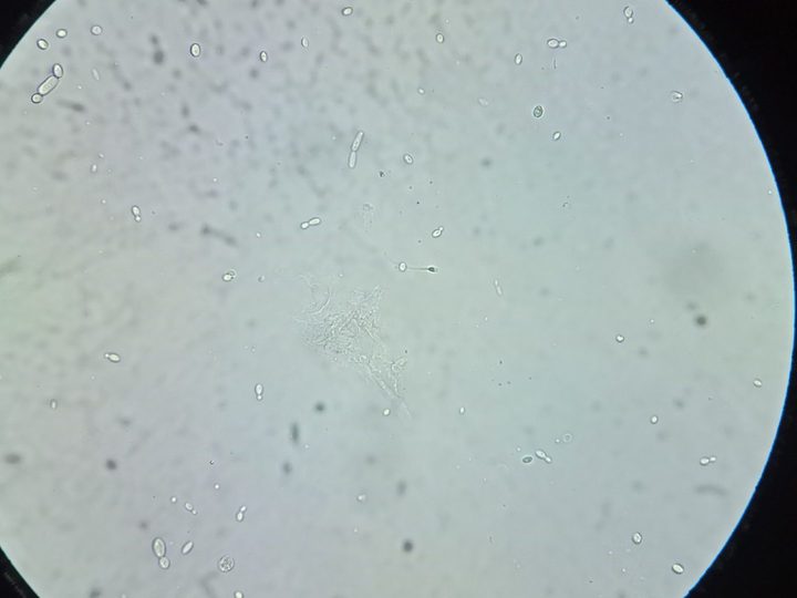 Native urine sediment preparation: yeast-like fungi and mucus element in the field of view