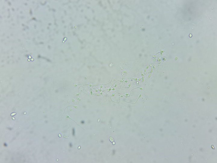 Microscopy of urine sediment: cluster of spermatozoa and single yeast cells