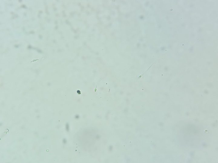 Native urine sediment preparation: individual spermatozoa with thin flagella