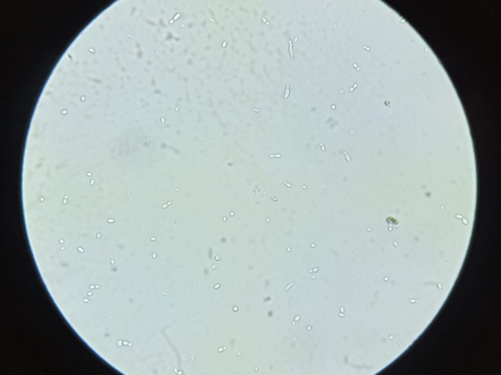 Microscopy of urine sediment: multiple yeast cells at various budding stages