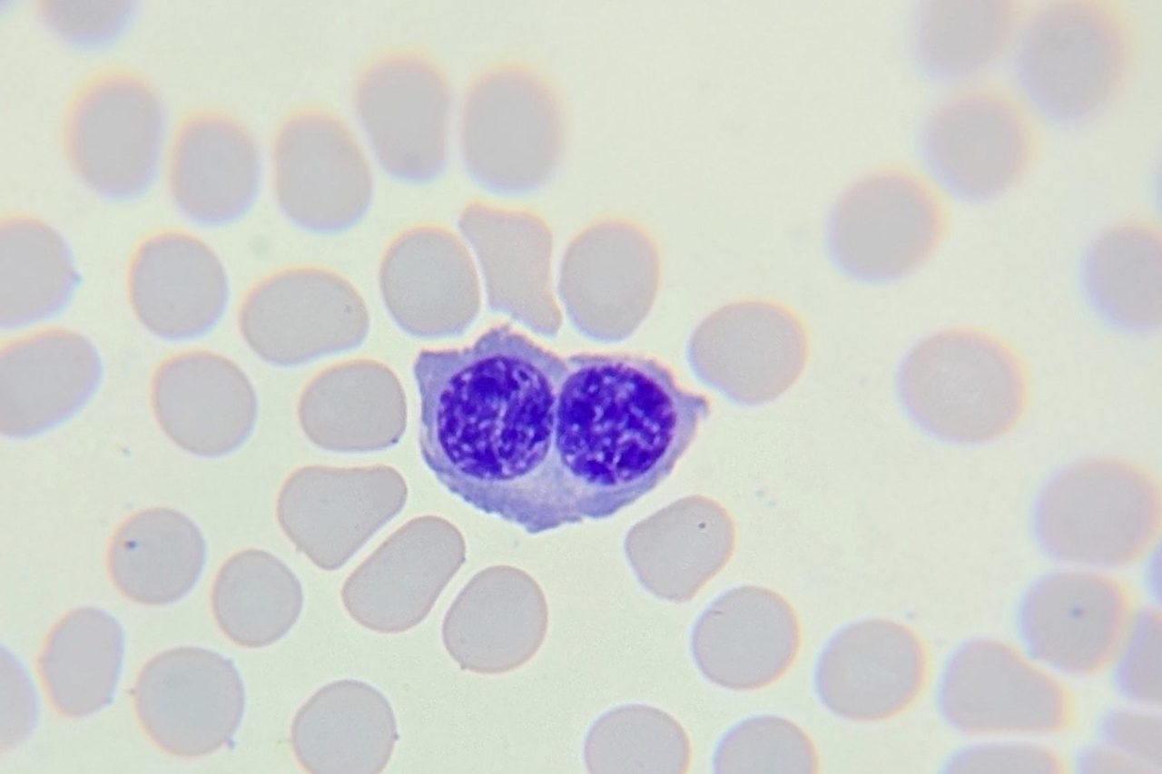 Binucleated Normoblast in Peripheral Blood Smear