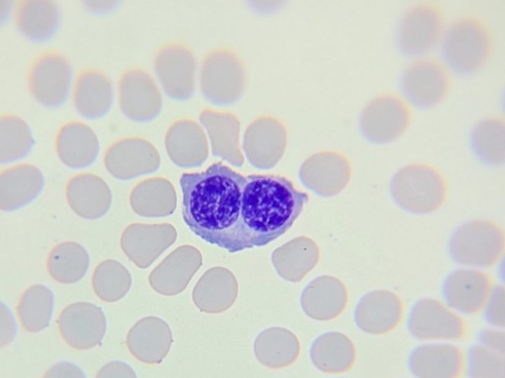 Blood smear: binucleated normoblast among mature erythrocytes