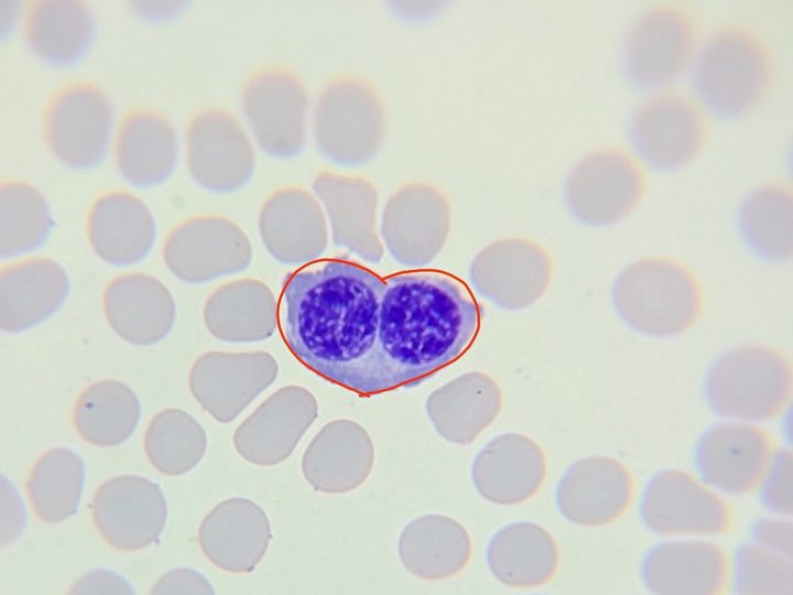 Blood smear: binucleated normoblast, outlined with a heart shape