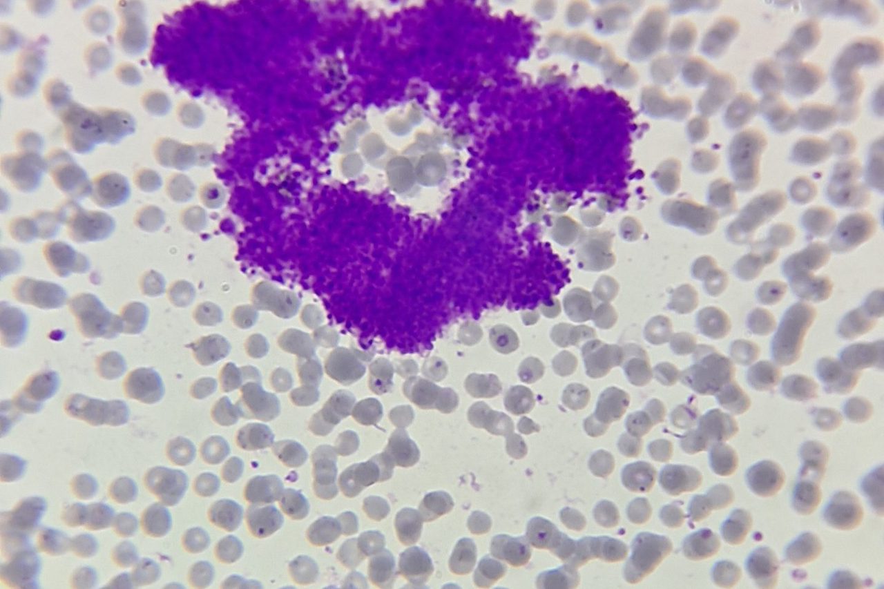 EDTA-Induced Pseudothrombocytopenia in Blood Smear