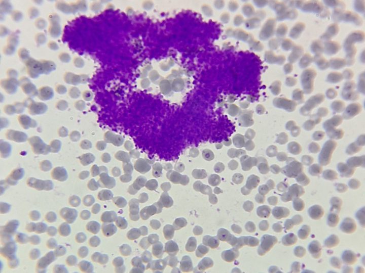 Blood smear, large ring-shaped platelet aggregate