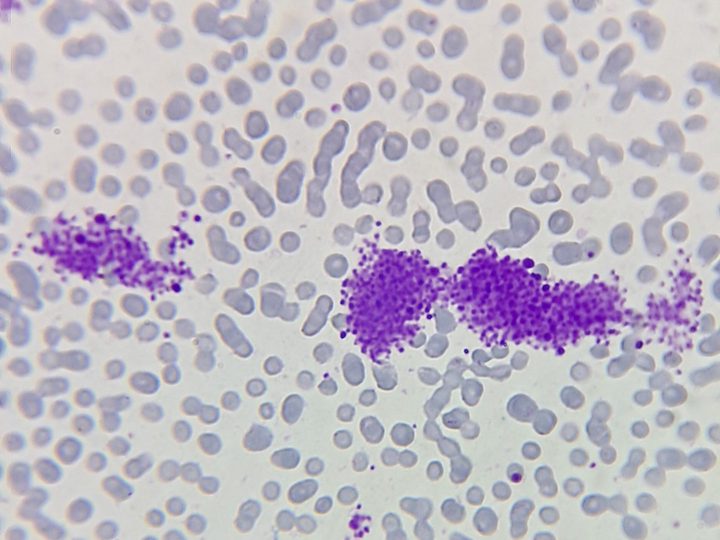 Blood smear, elongated clusters of aggregated platelets