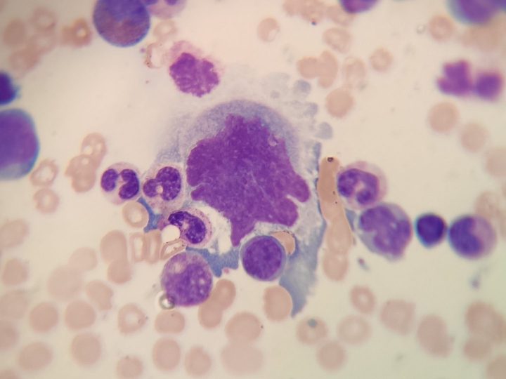 Bone marrow smear, emperipolesis: leukocytes in the cytoplasm of a megakaryocyte