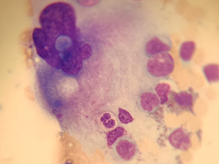 Bone marrow smear, intact hematopoietic cells inside a megakaryocyte