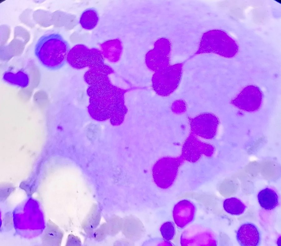 Emperipolesis in Megakaryocytes: Bone Marrow Aspirate