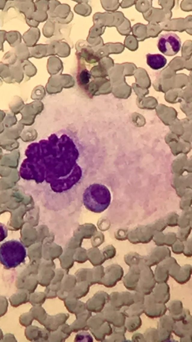 Emperipolesis in Megakaryocytes: Bone Marrow Cytology