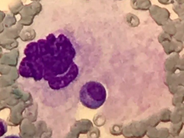 Bone marrow smear: megakaryocyte with emperipolesis, ×1000