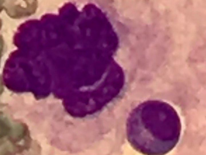Smear fragment: megakaryocyte nucleus and intact cell in the cytoplasm