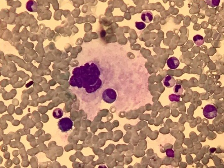 Overview smear of bone marrow aspirate: megakaryocyte in the field of view
