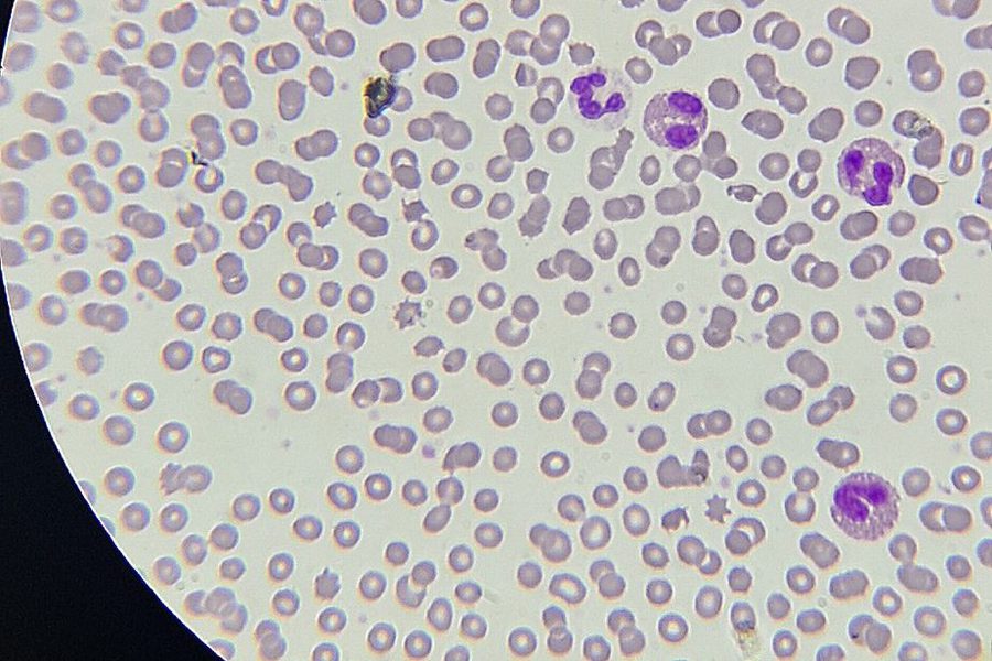 Eosinophilia in a Blood Smear During an Allergic Reaction