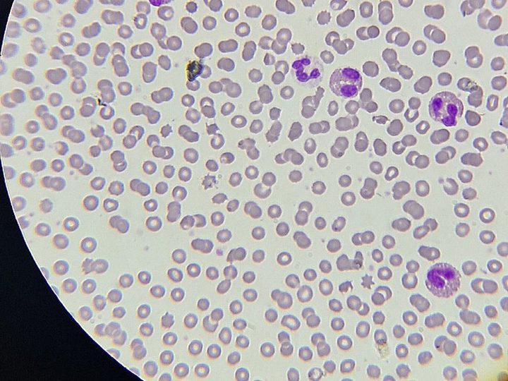 Blood smear, several eosinophils and a segmented neutrophil in the field of view
