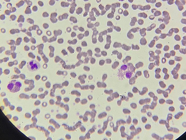 Blood smear, eosinophils with typical oxyphilic cytoplasmic granulation