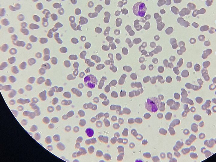 Blood smear, eosinophils and lymphocytes in pronounced eosinophilia