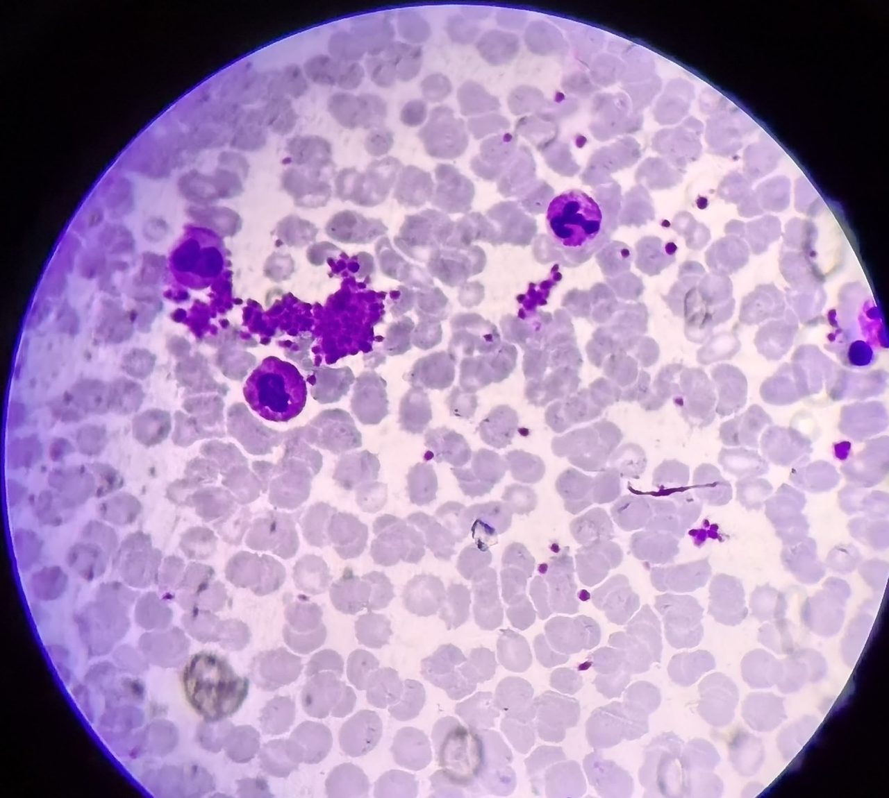 Erythremia: Peripheral Blood and Bone Marrow Findings