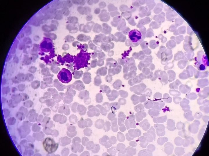 Bone marrow smear: large platelet aggregate and mature granulocytes