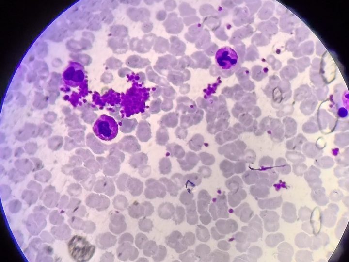 Bone marrow aspirate smear: platelet cluster and neutrophilic leukocytes