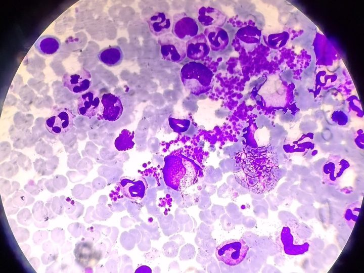 Bone marrow smear: granulocytic lineage expansion and platelet conglomerate