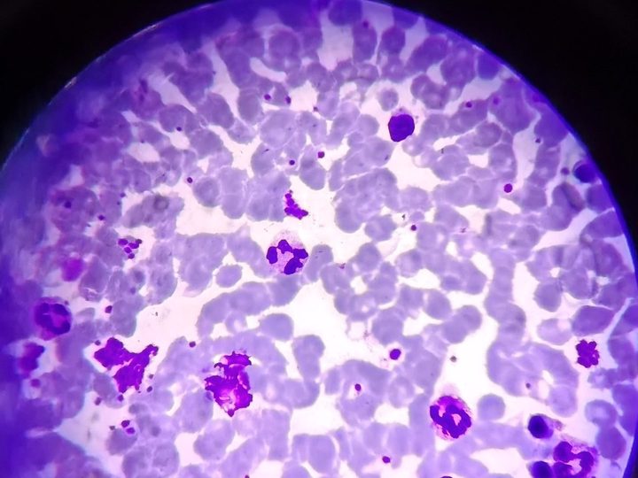Bone marrow preparation: dense platelet casts and segmented neutrophils