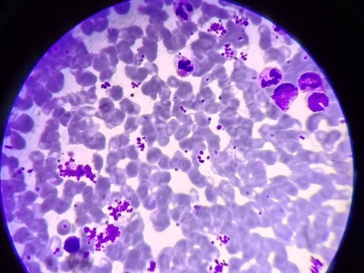Bone marrow smear: multiple platelet clusters and plates in the field of view