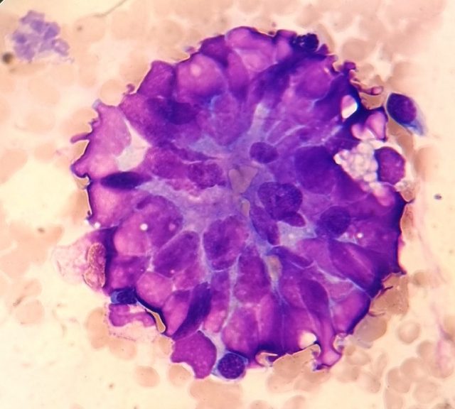 Erythroblastic Islands in Bone Marrow Smears