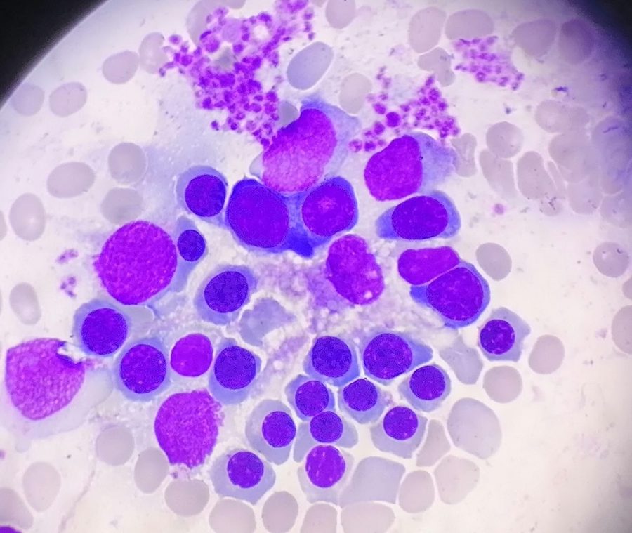 Erythroblastic Islands in Bone Marrow Smears