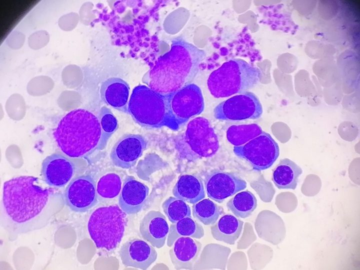 Bone marrow smear: erythroblastic island with macrophage and normoblasts